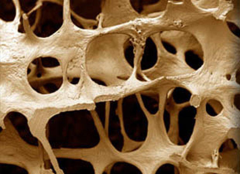 Osteoporosis facts drug companies don’t want you to know