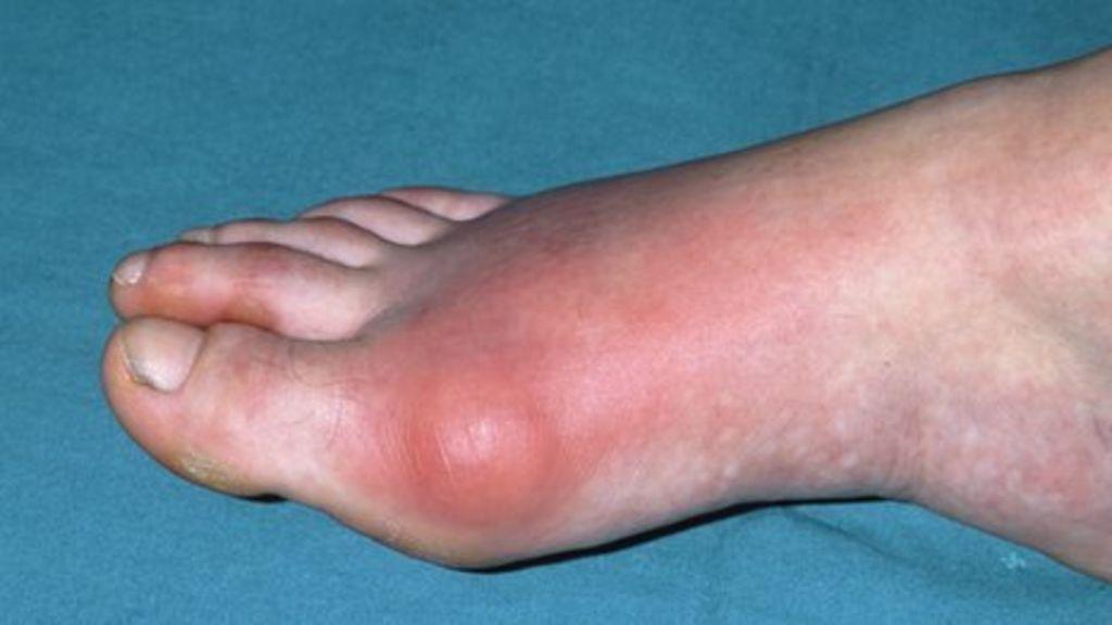 Got gout? End it in 24 hours or less!
