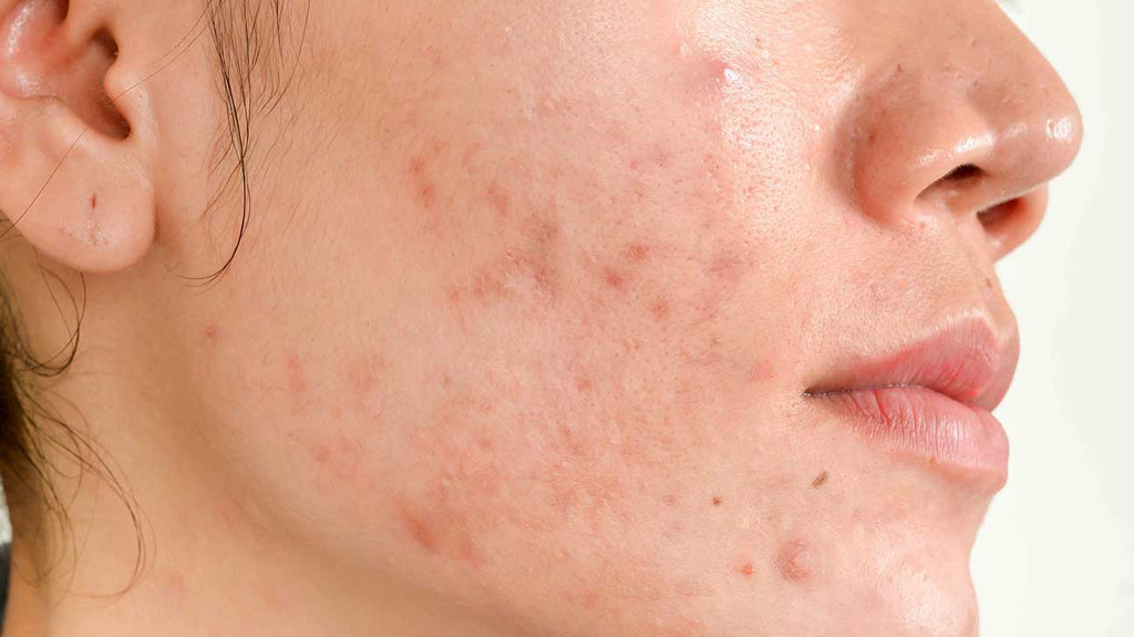 Surprising causes (& remedies) for acne