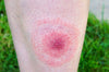 Tired? Joint aches? It could be Lyme disease!