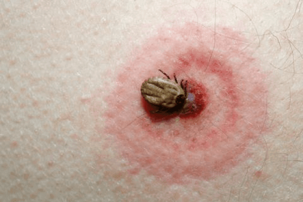 The complete story on Lyme disease—what you must know