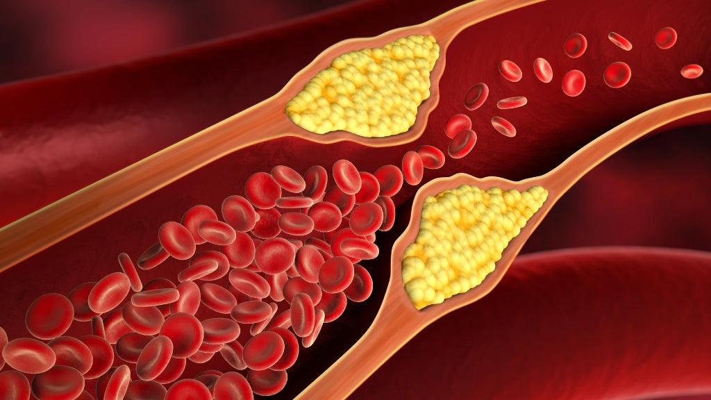 Read this before you take a statin for cholesterol!