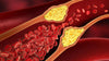 Read this before you take a statin for cholesterol!