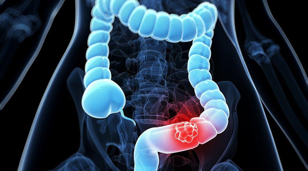 Colorectal cancer—what you must be aware of