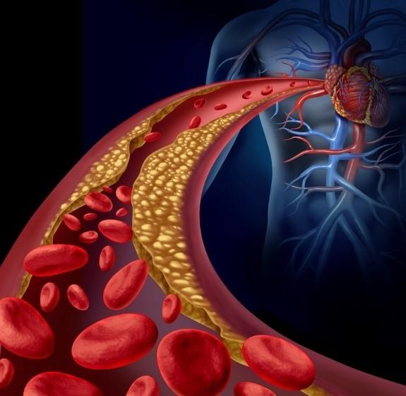 How to safely and naturally lower your cholesterol