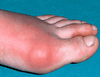 Natural remedies for gout