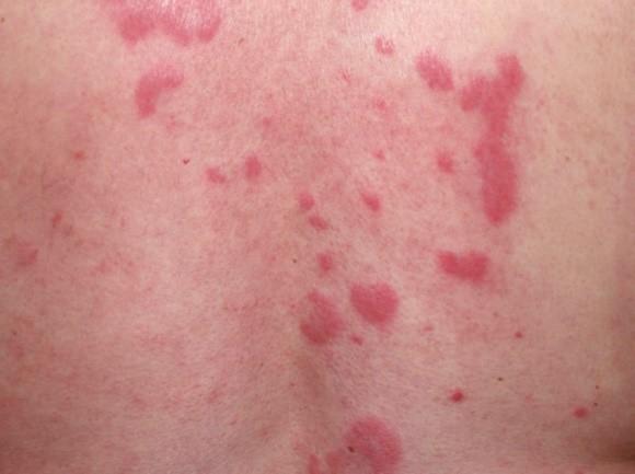 Lupus Roxo What you don’t know about lupus—and how to fight it